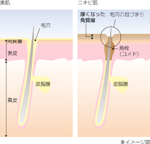 ニキビができるのはなぜ？